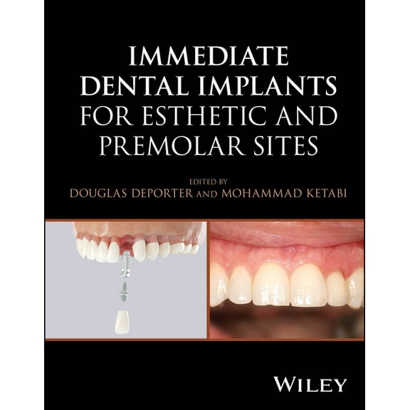 Immediate Dental Implants for Esthetic and Premolar Sites, (Hardcover)