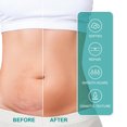 thumbnail image 4 of KUIZAP Scar Care Spray Fade Scar Pregnancy Surgery Scar Smoothing Skin Care spray, 4 of 5
