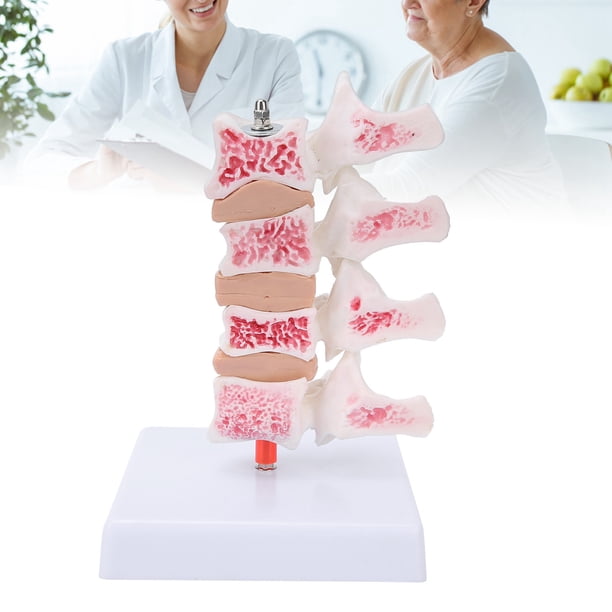 Modelo De Osteoporosis De La Columna Vertebral, Modelo De Anatomía Modelo Anatómico De La Columna Vertebral Para La Enseñanza Para La Exposición Del Modelo Para Una