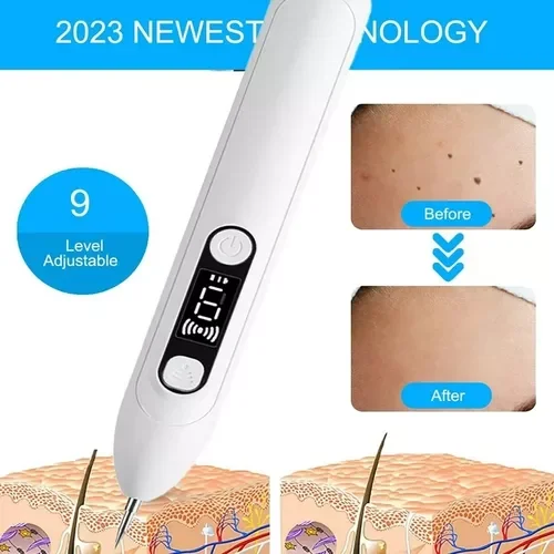 Pluma Eliminador De Verrugas Lunares Manchas Pecas Mezquinos Beaustat