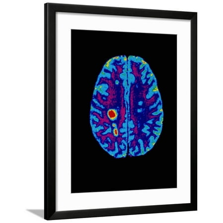 Col. MRI Scan of a Brain with Multiple Sclerosis Framed Print Wall Art By Science Photo (Best Way To Scan Multiple Photos)
