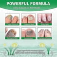 thumbnail image 5 of Nail Fungus Treatment, Ginger Nail Fungus Treatment, 7 Days Nail Fungus Treatment for Toenail, 5 of 5