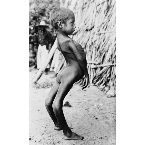 Deformed Mexican Boy History (24 x 36)