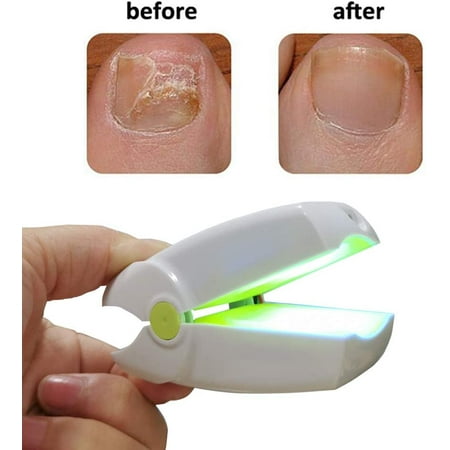 Global Care Market® Nail Cleaning Laser Device – Nail Fungus Treatment Improves The Health of Unsightly Fingernails and Toenails