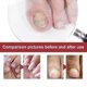 thumbnail image 2 of Nail Treatment Solution For Crooked Nails, Soft Nails, Thickened Nails, Unwell Nails An, 2 of 4