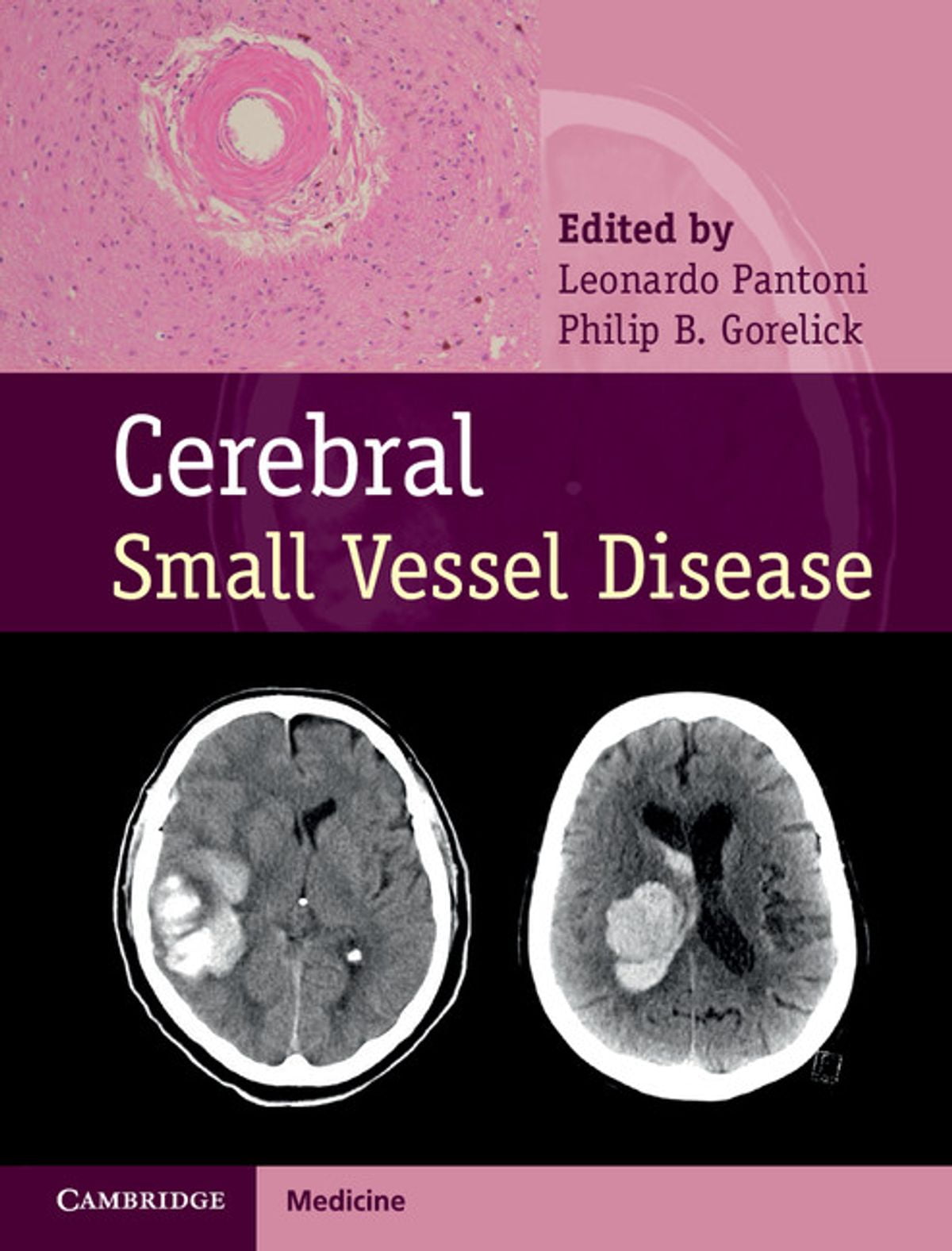 Cerebral Small Vessel Disease - eBook - Walmart.com - Walmart.com
