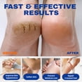 thumbnail image 3 of Crema de urea SKIN ULTIMA 40% con 2% de ácido salicílico para pies 150, 3 of 5
