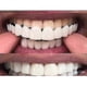 thumbnail image 3 of Upper/lower Comfort Fit Flex Whitening Denture Braces, 3 of 5