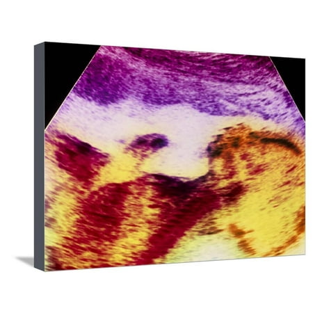 Ultrasound Scan of 20 Week Old Foetus (side View) Stretched Canvas Print Wall Art By Science Photo (Best Way To Scan Old Photos Onto Computer)