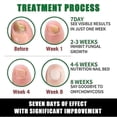 thumbnail image 3 of 1-3pcs Ginger Anti Fungal Nail Treatment Repair Finger Toe Care Nail Fungus Liquid, 3 of 5