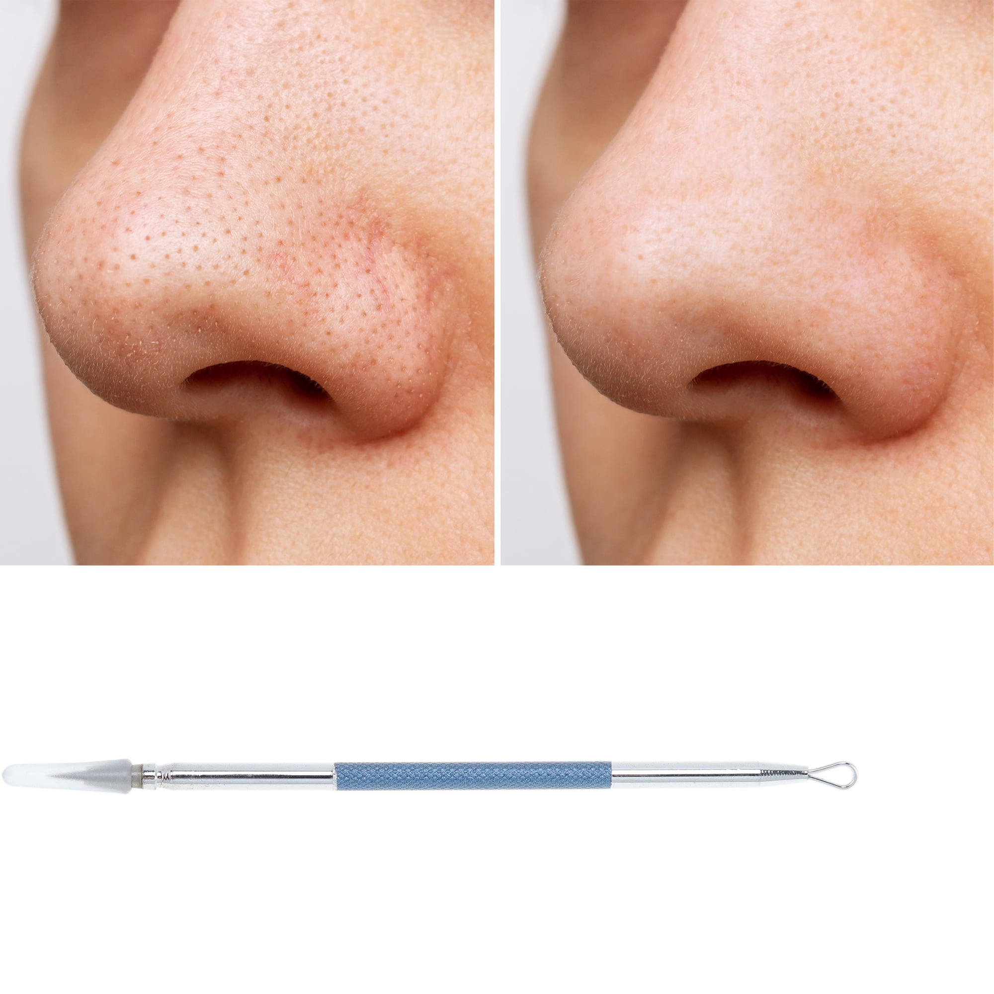 Unique Bargains 1pc Facial Double-Headed Pimple Extractor Tool for Skin Care Dark Blue