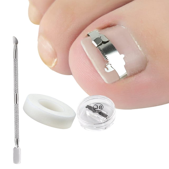 Herramienta de corrección de uñas encarnadas Colcomx tratamiento