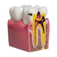 thumbnail image 1 of Modelo de caries dental 6 veces Estructura de automóvil de resina 315x217x335 Herramienta de aprendizaje educativo compacto para la demostración de au, 1 of 9
