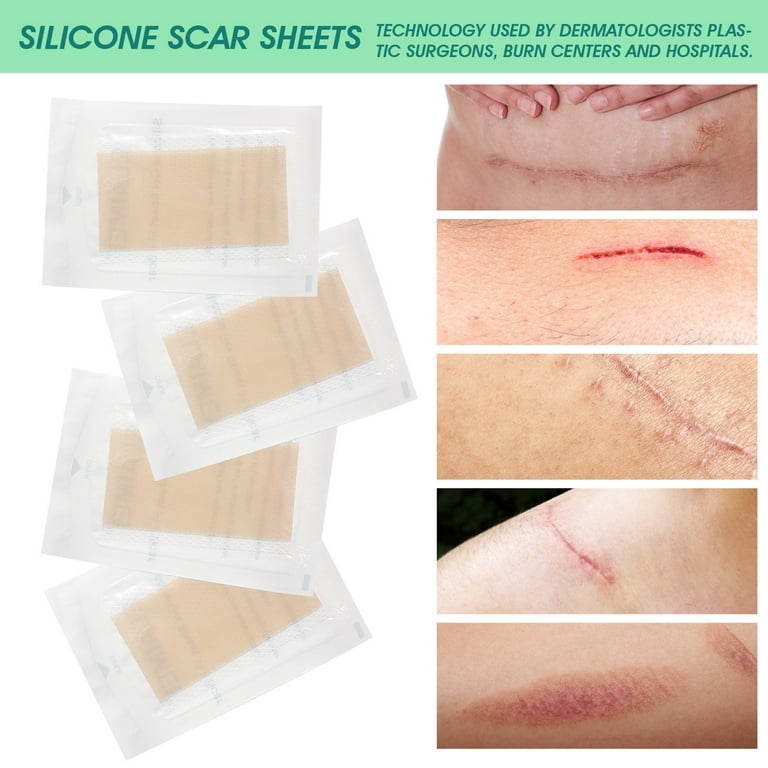 Silicone gel scar treatment sheets deals