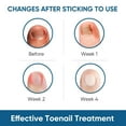 thumbnail image 2 of Ingrown Toenail Correction Kit, 50-Piece with Toenail File & Lifter, 2 of 8