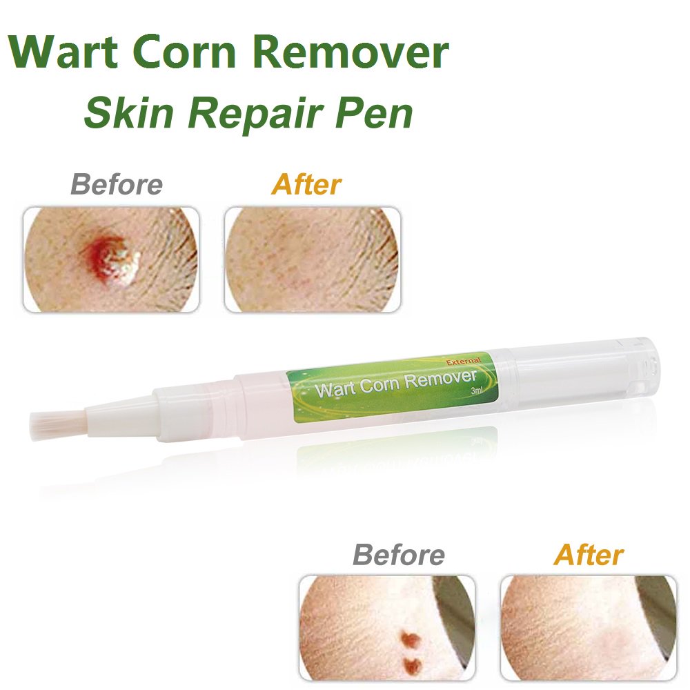 Skin Tag Remover Mole Remover Skin Tag Removal Foot Patch Removal 3ml