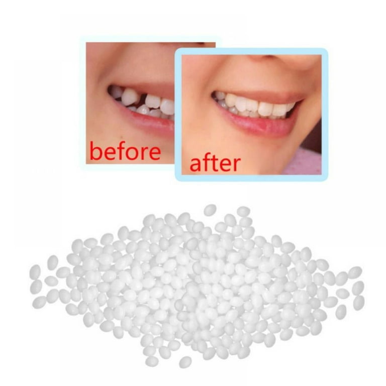 Temporary Tooth Repair kit for Temporary Fixing Missing and Broken Tooth  Moldable Fake Teeth and Thermal Beads Replacement Kit (Size : 1)