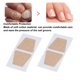 thumbnail image 3 of Parche Corrector De Uñas Encarnadas, Cómodo Y Transpirable Parche Para Eliminar Uñas Encarnadas, 20 Piezas Para Exteriores, 3 of 8