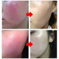 thumbnail image 5 of Crema de reparación de rojeces faciales, reparación de 7 días, reparación de Rosacea de la piel roja, mejora la piel sensible, cuidado cosmético coreano, 5 of 5