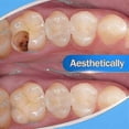 thumbnail image 3 of strong dental cement for tooth repair and restoration, 3 of 5