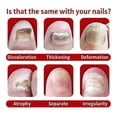 thumbnail image 3 of west u0026 month antifungal oil for nail repair and soothing foot care, 3 of 5