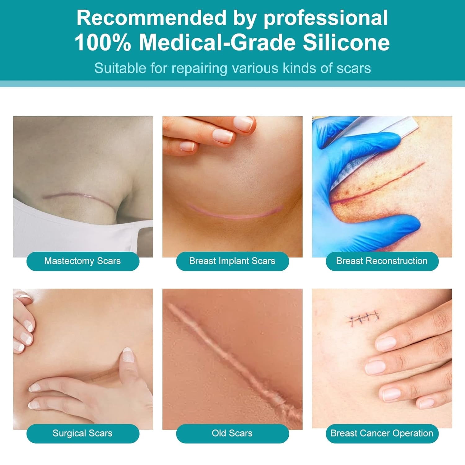 Silicone Scar Sheets, 4 Pair Silicone Scar Tape for Breast, Reusable and Effective Scar Removal