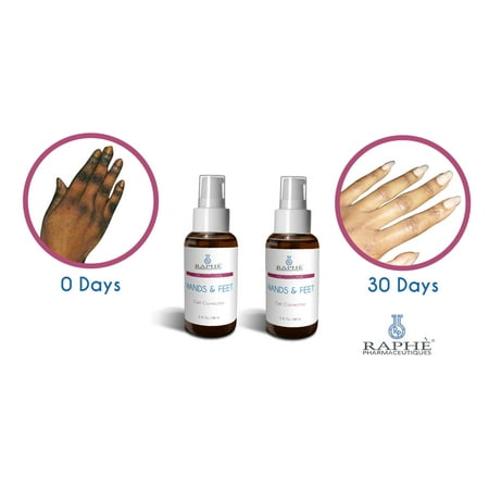Hydroquinone Gel Pre-Neutralized Dark Hands and Feet Treatment Solution: Hands N Feet Gell Corrector For Hydroquinone Damaged Digits. 16oz ()
