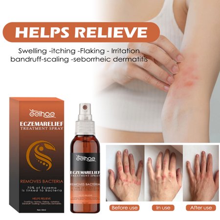 Skin Relief Mist, Body Skin Care Psoriasis Redness, Itching, Dry Repair Mist