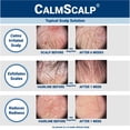 thumbnail image 3 of CalmScalp® Topical Serum Scalp Solution, 3 of 8