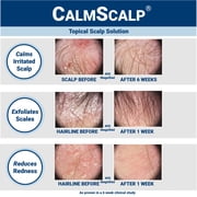 CalmScalp® Topical Serum Scalp Solution