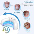 thumbnail image 5 of Nail Fungal Laser Device, Nail Fungus Treatment for Toenai, Laser-Device for Finger and Toe Nail Fungus Removal, 5 of 5