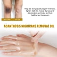 thumbnail image 3 of Aceite de Quiebra de Acantosis nigricans, no Grasiento Iluminan El Tono de la Piel Acantasis Nigricans Aceite 3 piezas de 50 ml para tobillos, 3 of 7