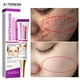 thumbnail image 1 of Crema blanqueadora facial para eliminar pecas, Corrector de manchas oscuras de Melasma, crema blanqueadora de melanina, aclarador de cicatriz de acné, cuidado de la piel Fivean unisex, 1 of 1