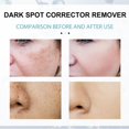 thumbnail image 4 of Crema para eliminar manchas oscuras, alivia la cara, el cuerpo, la edad, pigmentación, cuidado de la piel, hidratante Facial antienvejecimiento, 4 of 5