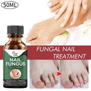 Tissouoy Nail Fungus Treat Onychomycosis Toe Treat Feet Anti Infection Nails Care Product,50ml