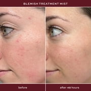 ITK Skincare Blemish Mist Acne Treatment With 2% Salicylic Acid for All Skin Types, 3.3 oz