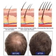 thumbnail image 2 of 50% Off,5% Minoxidil Foam Kit For Men - Hair Regrowth Treatment 60g, 2 of 3