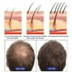 thumbnail image 2 of 50 % de descuento, 5 % Minoxidil Foam Kit For Men - Tratamiento para el crecimiento del cabello 60 g, 2 of 3