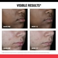 thumbnail image 5 of Neutrogena Stubborn Marks PM Treatment with Retinol SA, 1 fl. oz, 5 of 8