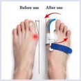 thumbnail image 5 of Corrector, Hallux Valgus Corrector, 5 of 5