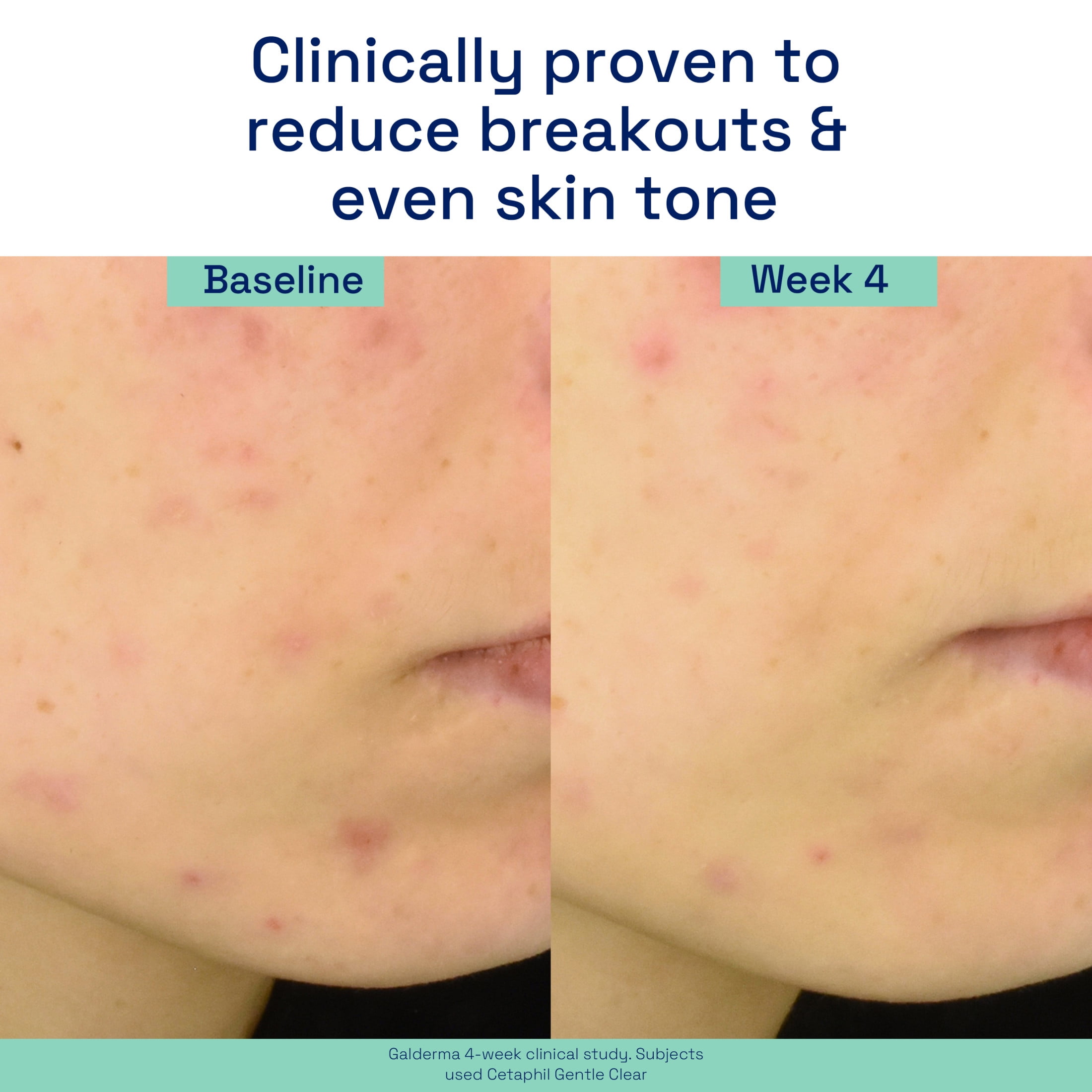 Cetaphil Gentle Clear Triple-Action Acne Treatment Serum for Sensitive Skin, 1 oz