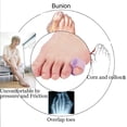thumbnail image 2 of Gel Toe Separators,10 Pack Pinky Toe Spacers For Overlapping Toes, Bunions, Big Toe Alignment,hammer Toe Straighteners, 2 of 5