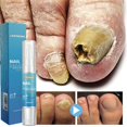 thumbnail image 4 of 1-5PCS 4ml Nail Antifungal Gel Anti-Infection Infected Nail Infection Nail Ringworm Nail, 4 of 5