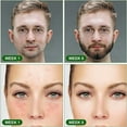 thumbnail image 5 of Derma Roller, Dermaroller facial de 0,5 mm, rodillo de microagujas para estimular el crecimiento del cabello y la barba, reduce la caída del cabello, cuidado de la piel del rostro,, 5 of 5