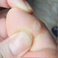thumbnail image 3 of 180pcs Plasters For Removal Of Fibromas, 3 of 5