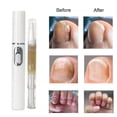 thumbnail image 5 of B Lápiz reparador de uñas con luz azul, tratamiento de hongos para uñas, crema nutritiva, antirestauración de uñas de los pies saludables, reparación de infecciones por hongos, 5 of 5