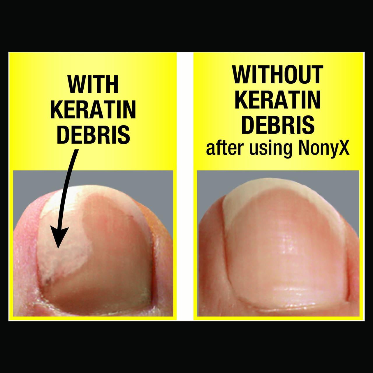 Remove Keratin Under Nails Best Nail Designs 2018 Nonyx Fungal Nail Clarifying Gel