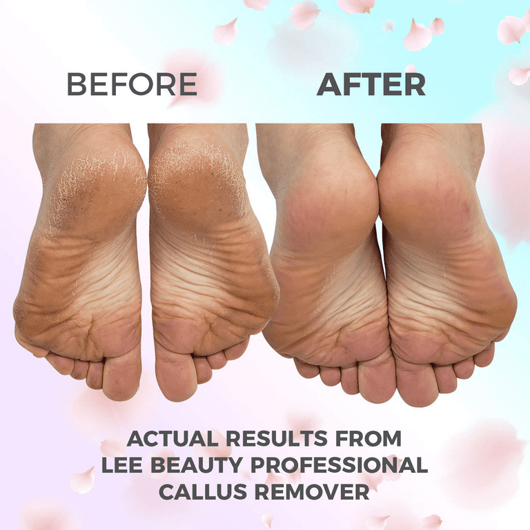 Feet Callus Remover Gel 12 Packs 8.4 oz with Pumice Stone Scrubber Kit for  Professional Pedicure Remove Hard Skins Heels Callouses Jasmine Scent 12  Pack - Jasmine Scent