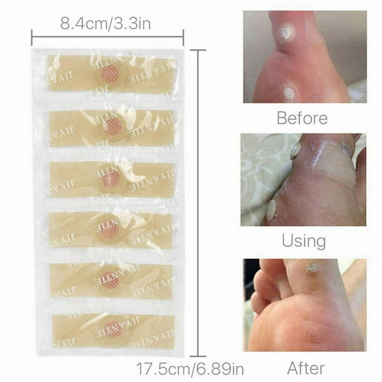 50 Pcs Foot Corn Remover Pads Plantar Wart Thorn Plaster Patch Callus  Removal