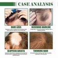 thumbnail image 5 of Aceite capilar Batana de 100 ml para espesar y estimular el crecimiento del cabello | Tratamiento nutritivo para el cuero cabelludo | Reduce la caída y el adelgazamiento del cabello, 5 of 5